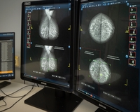 В 2023 году нейросети помогли проанализировать 100 тысяч маммографических исследований пациентов