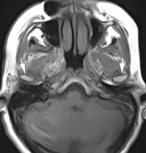 Рисунок 1 - Поперечное (аксиальное) изображение Т1 SE. Определяются головки мыщелковых отростков нижней челюсти (стрелки).