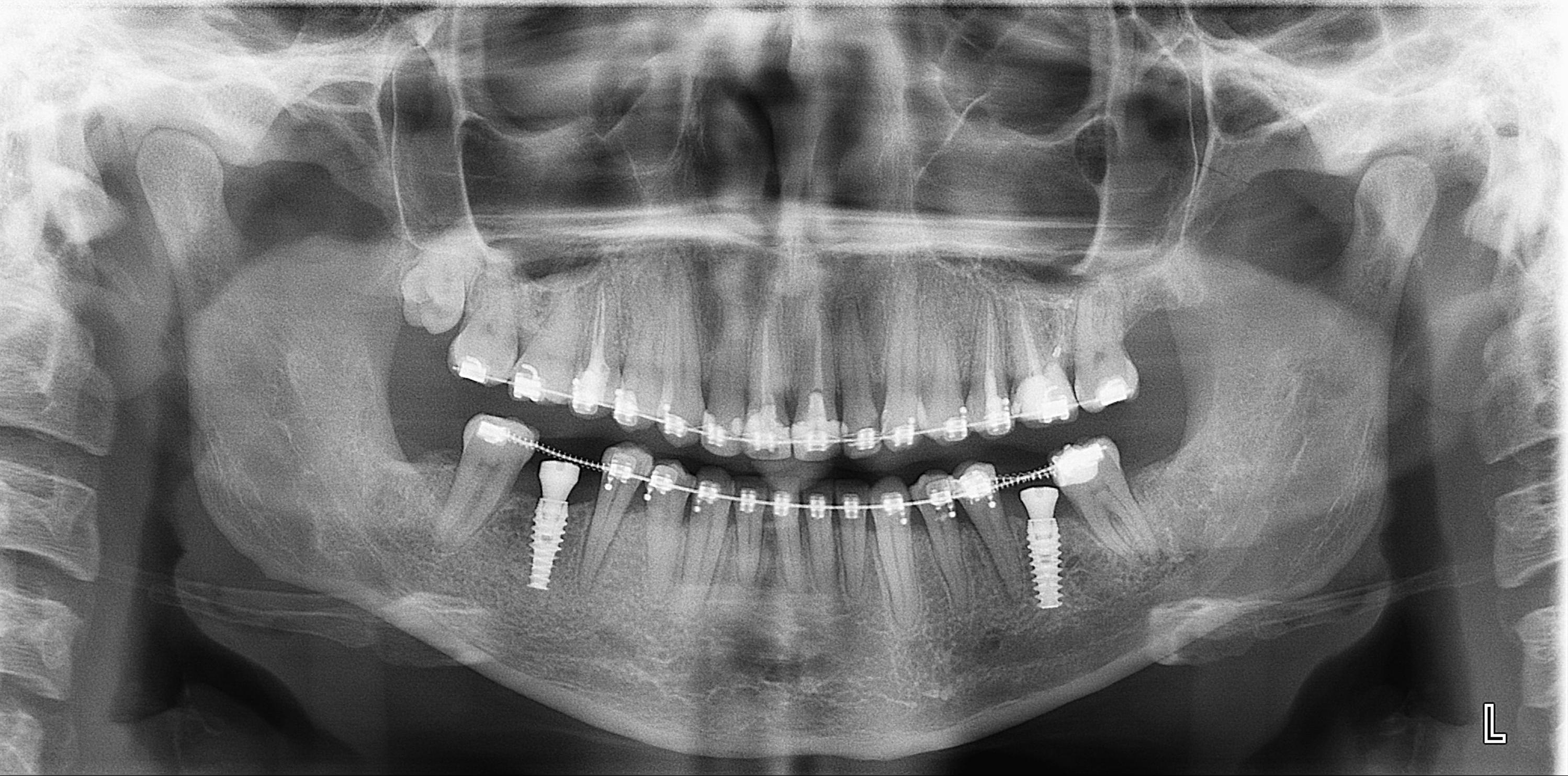 Расшифровка ортопантомограммы (ОПТГ) зубных рядов